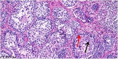 Epithelial–Myoepithelial Carcinoma of the Esophagus: A Case Report